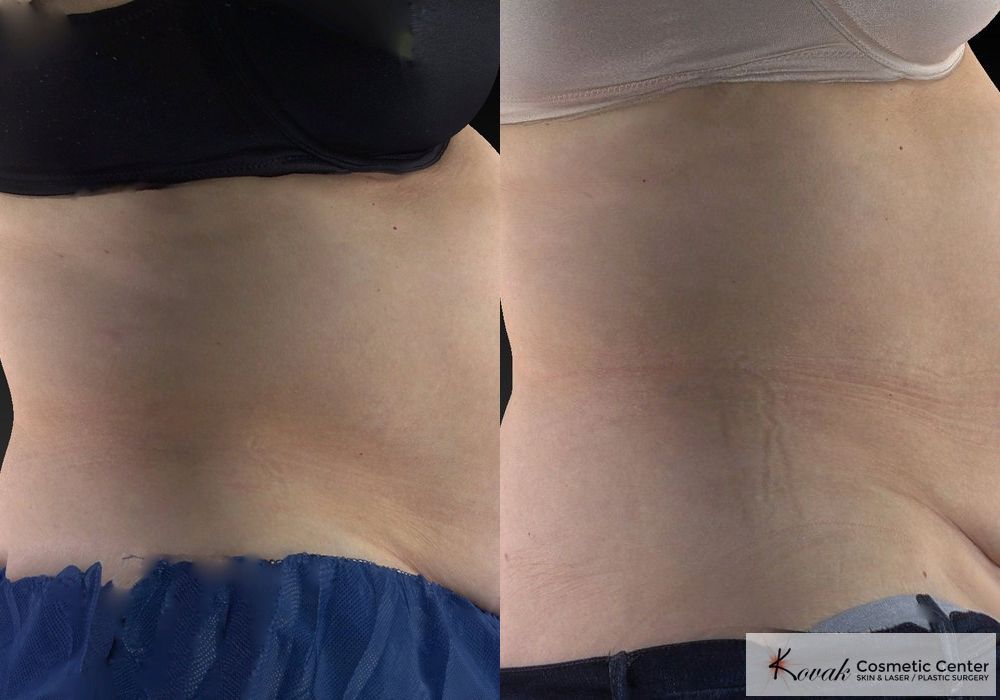 CoolSculpting® - Thumbnail 4