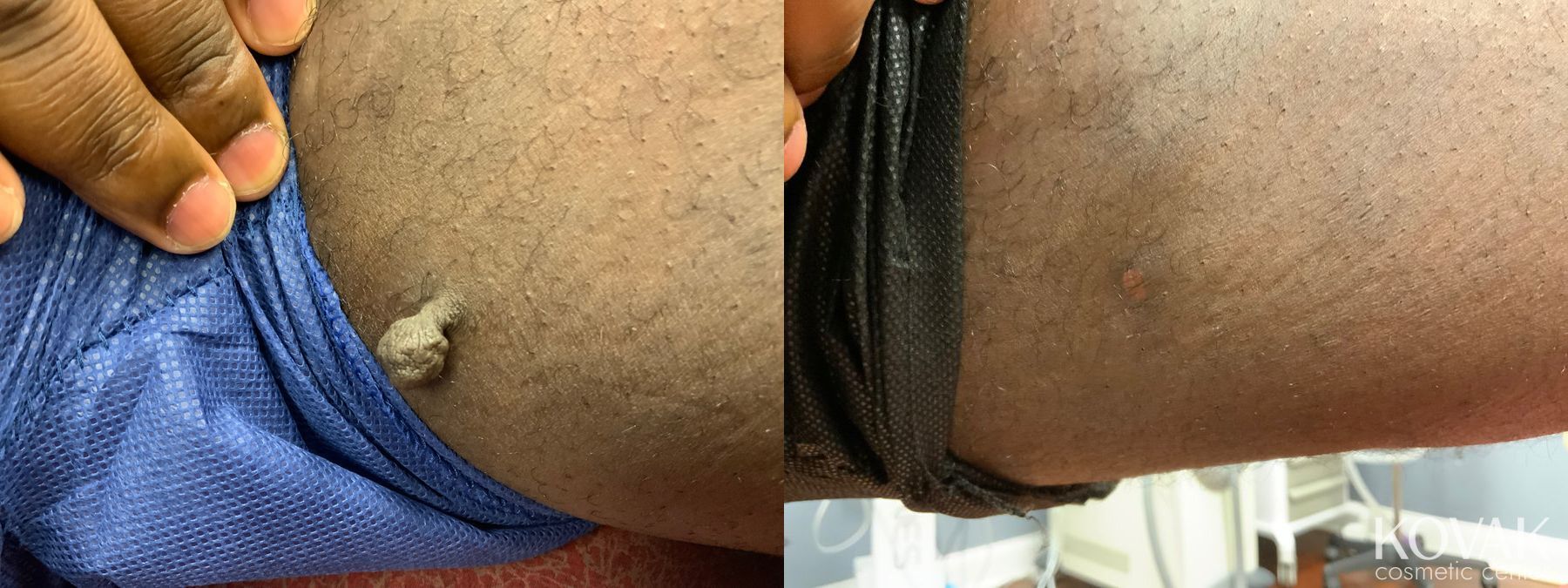 Before and after Skin Tag Removal case 36714