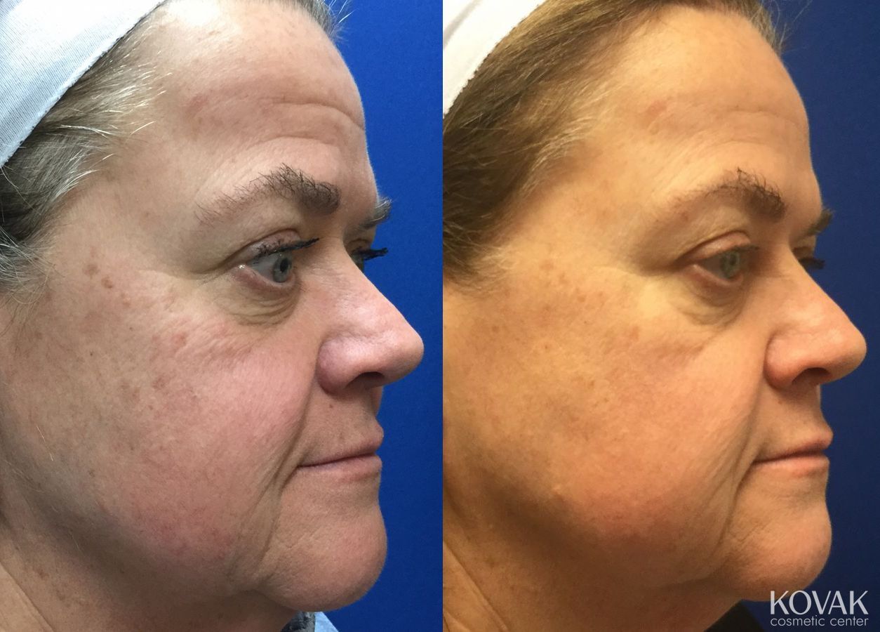 Before and after Restylane® Silk case 36645 - Angle 3
