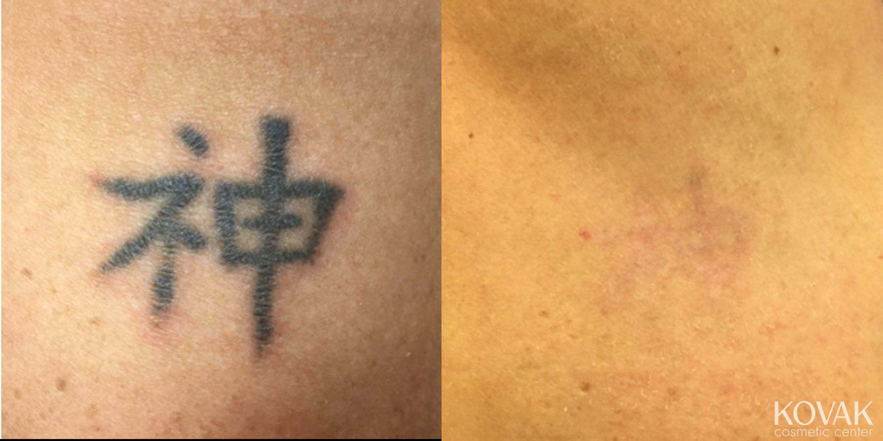Before and after Tattoo Removal case 36492