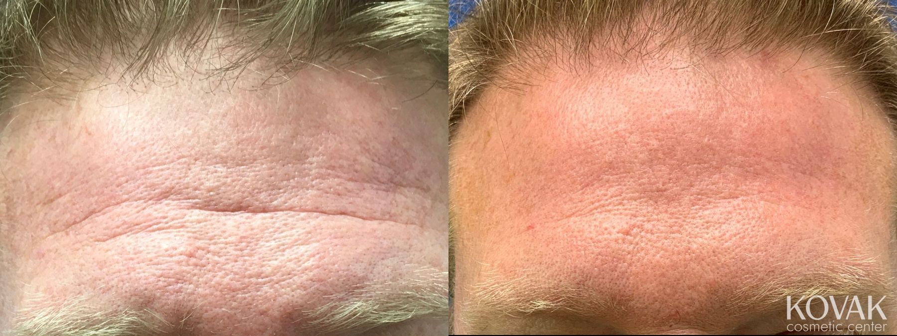 Before and after Forehead Lines case 36722