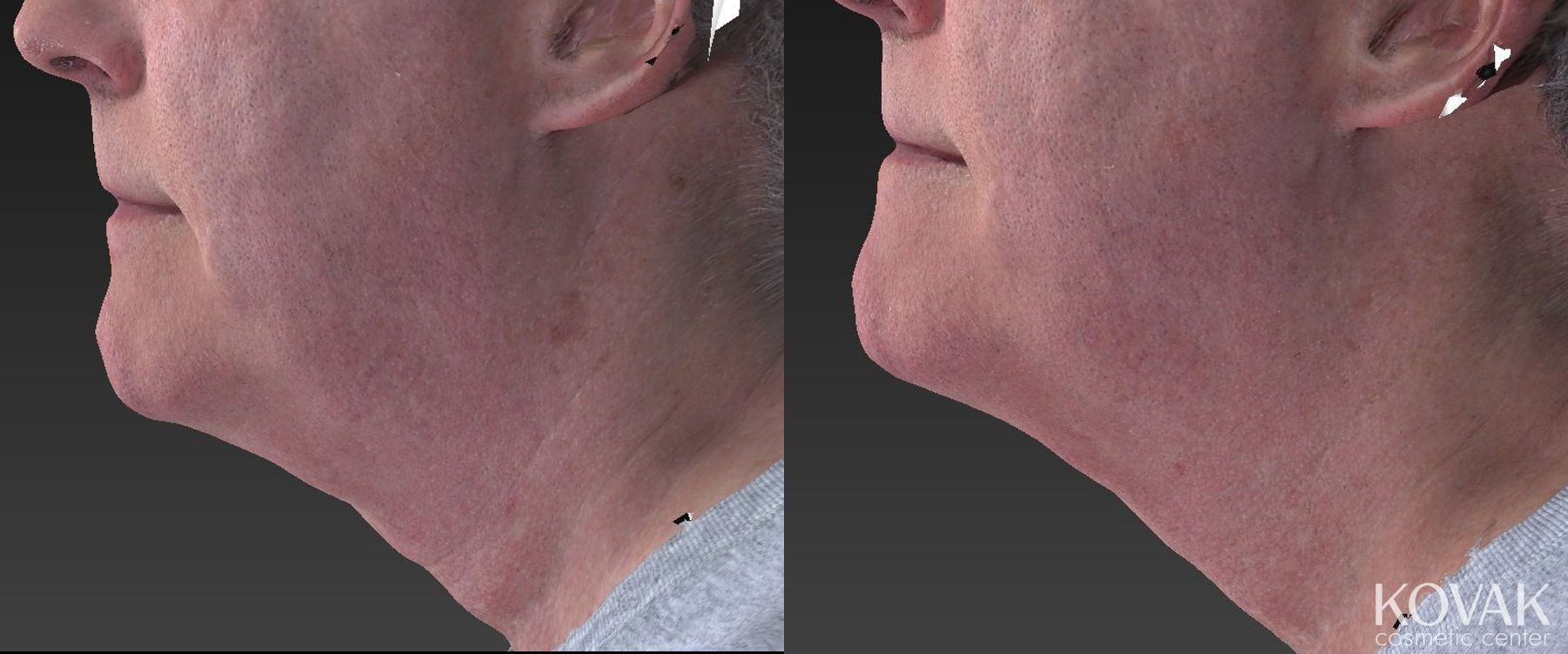 Before and after Injectables case 36638 - Angle 2