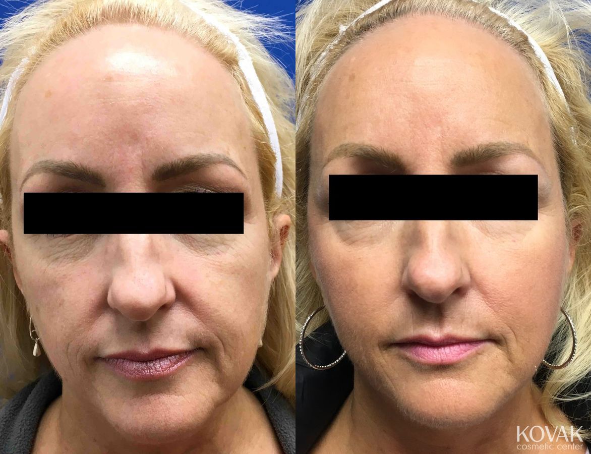 Before and after Sculptra® case 36672