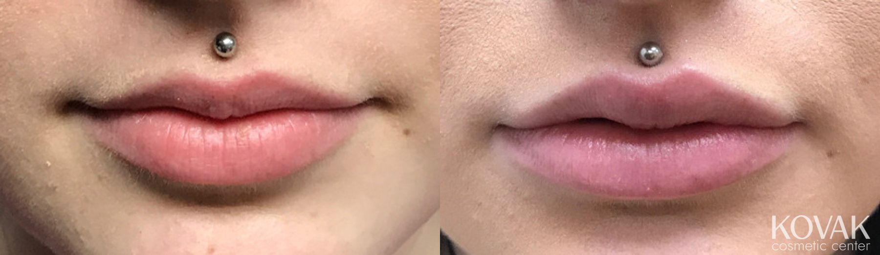 Before and after Juvéderm® XC case 36467