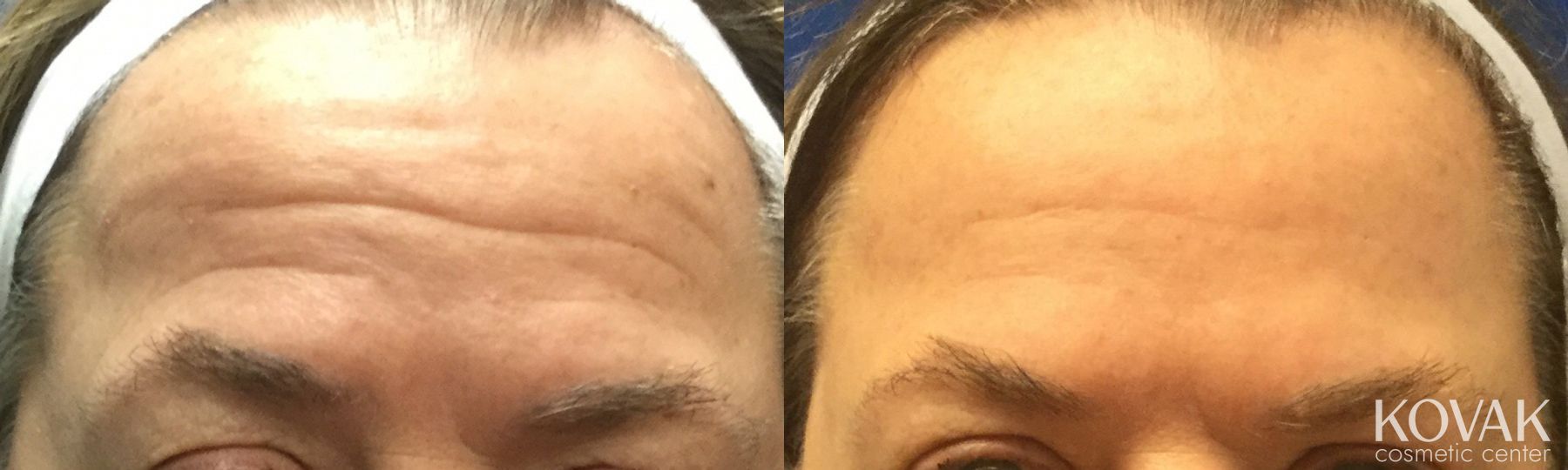 Before and after BOTOX® Cosmetic case 36643