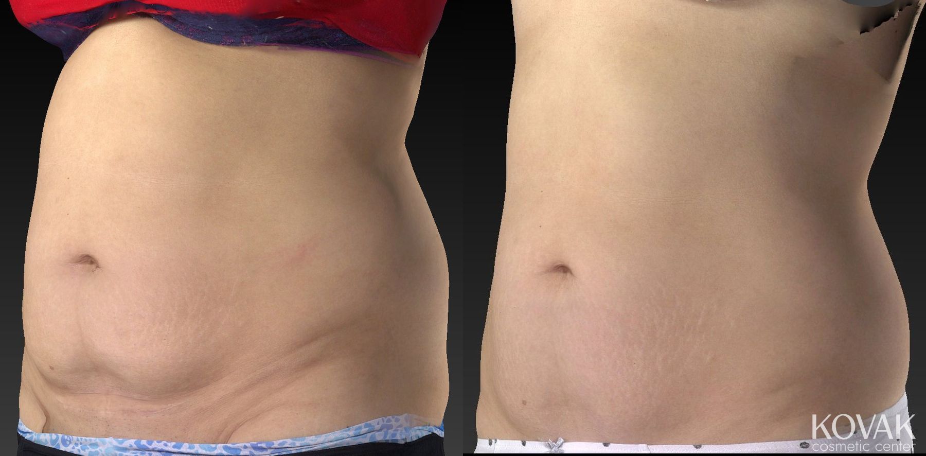 Before and after CoolSculpting® case 36602 - Angle 3