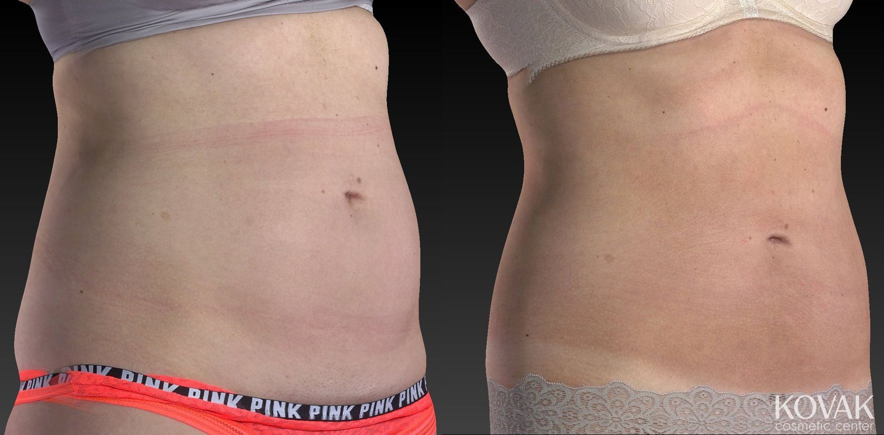 Before and after CoolSculpting® case 36619 - Angle 5