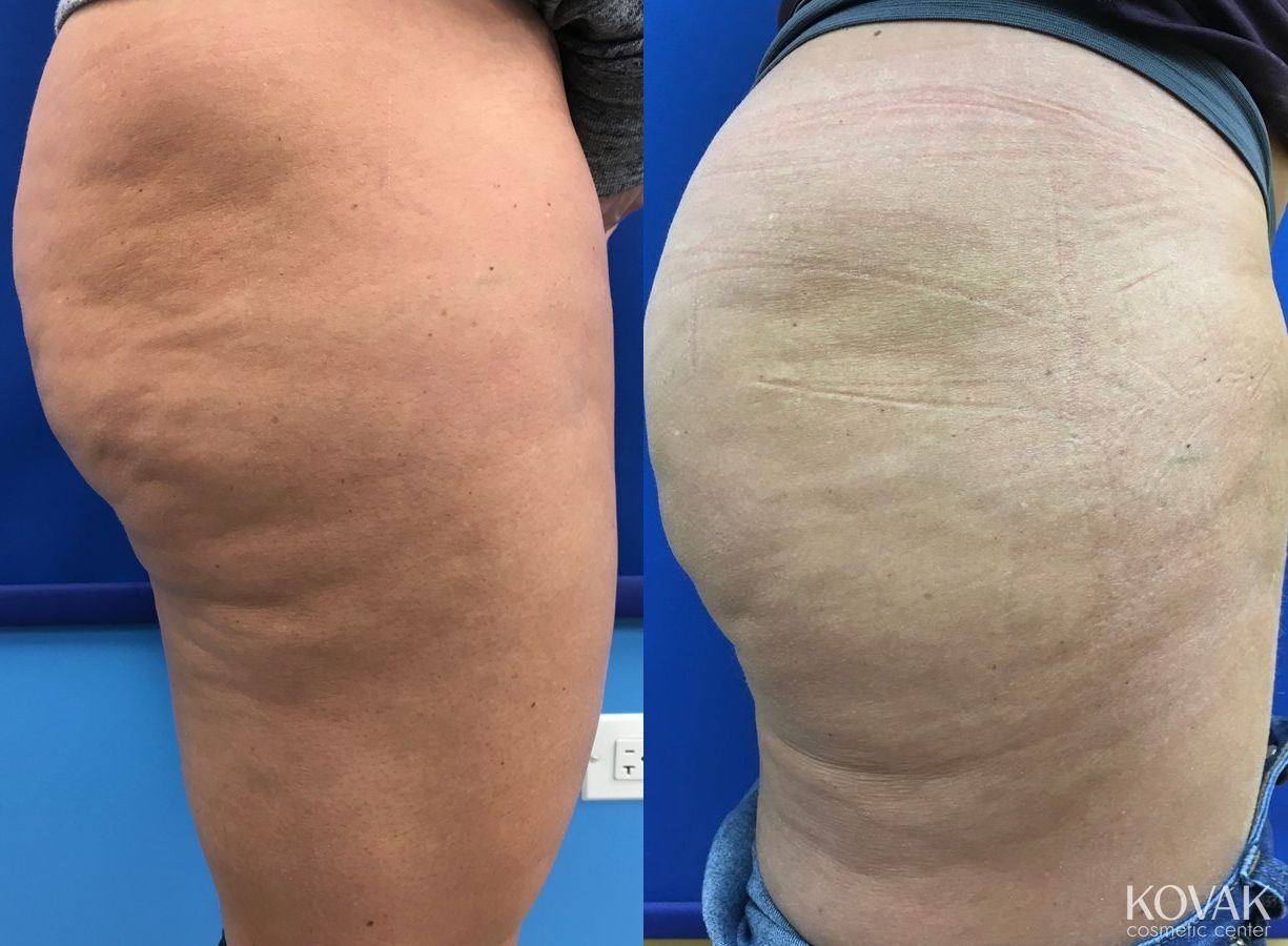 Before and after Cellulite Reduction case 36665 - Angle 3