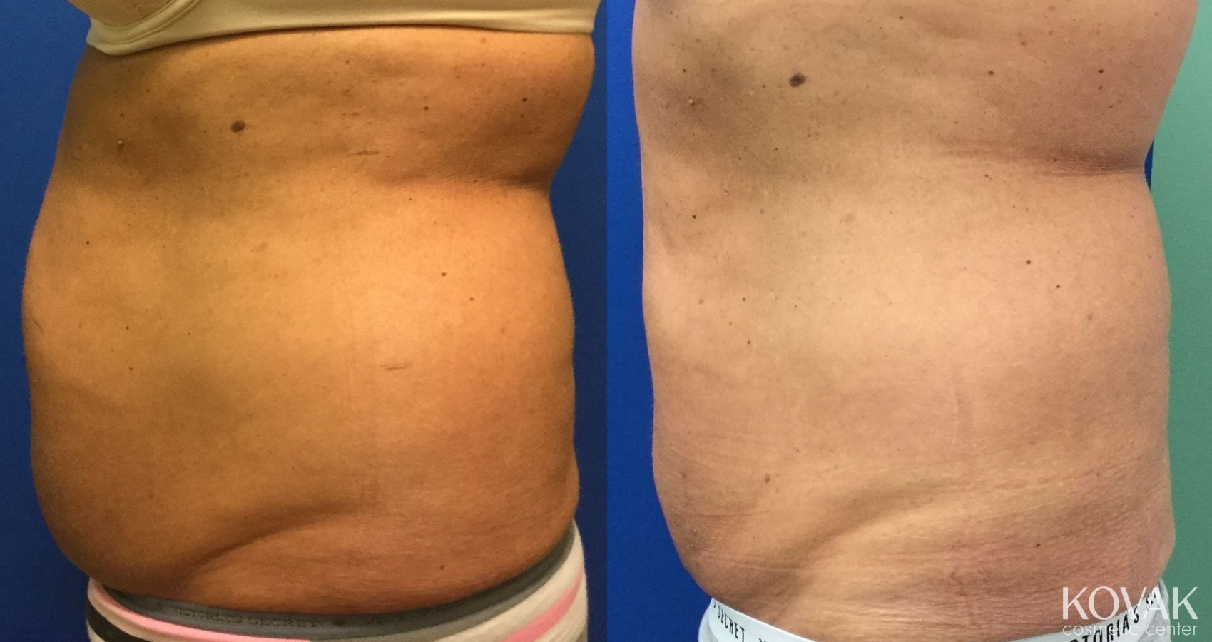 Before and after CoolSculpting® case 36465 - Angle 3