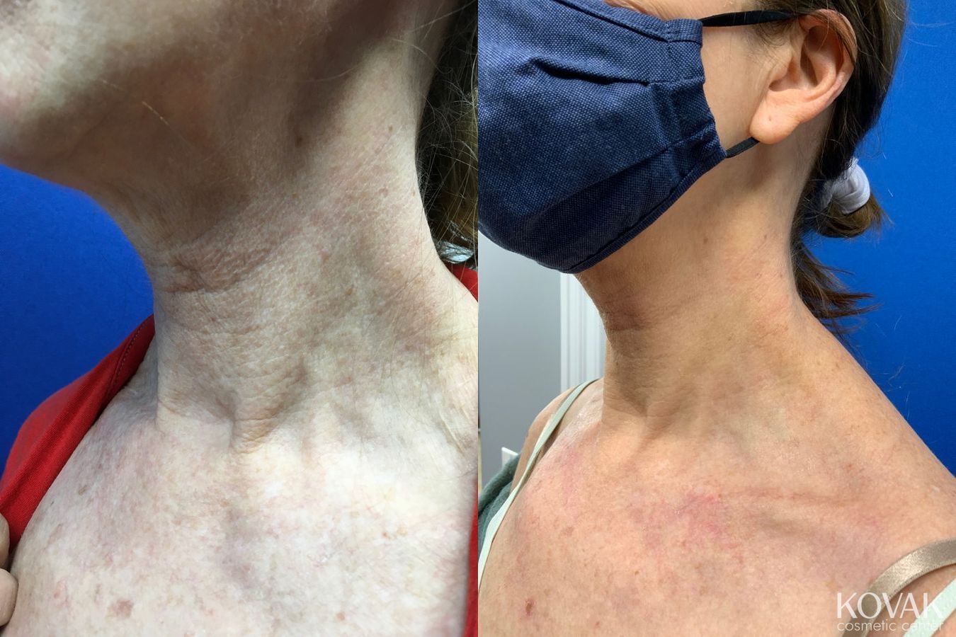 Before and after Microneedling with Scarlet case 36683 - Angle 2