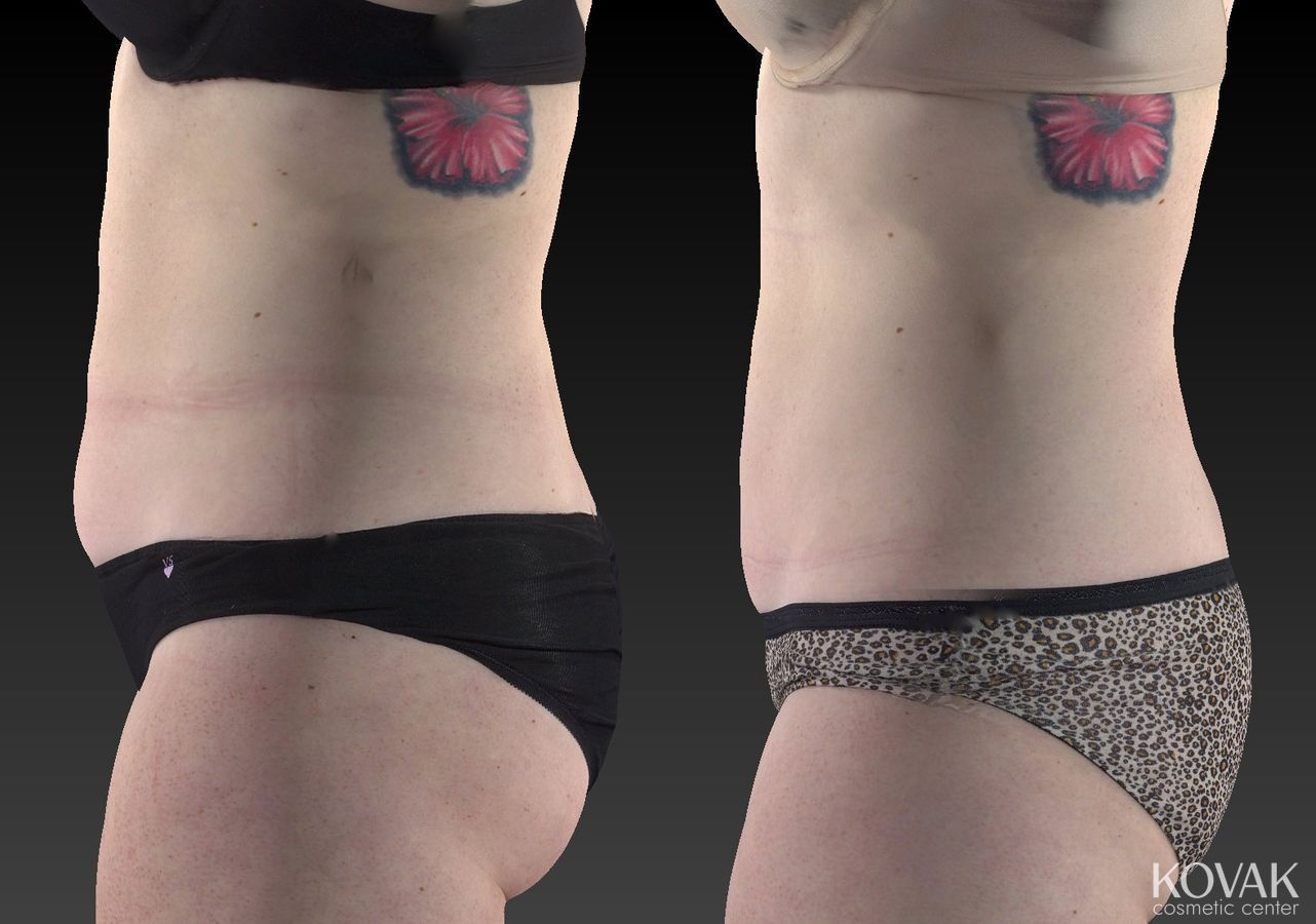 Before and after CoolSculpting® case 36604