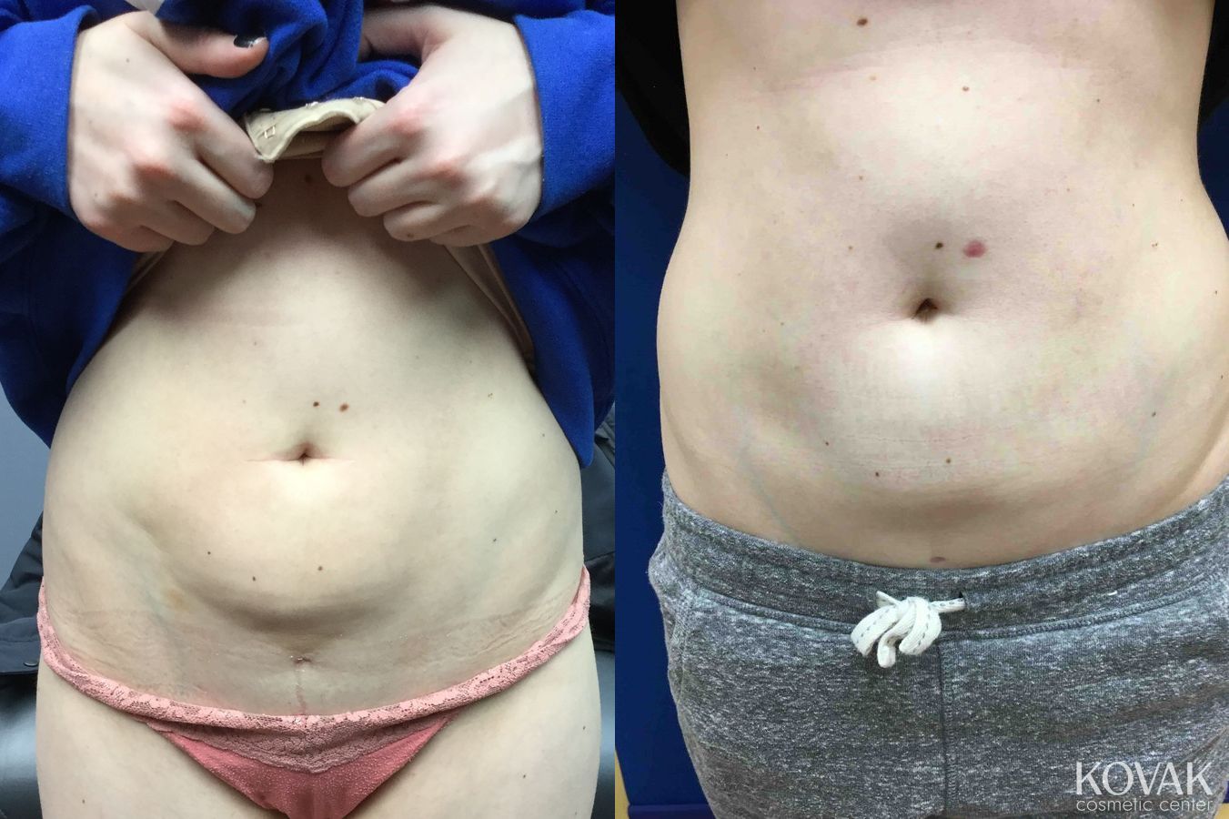 Before and after Laser Liposuction case 36613