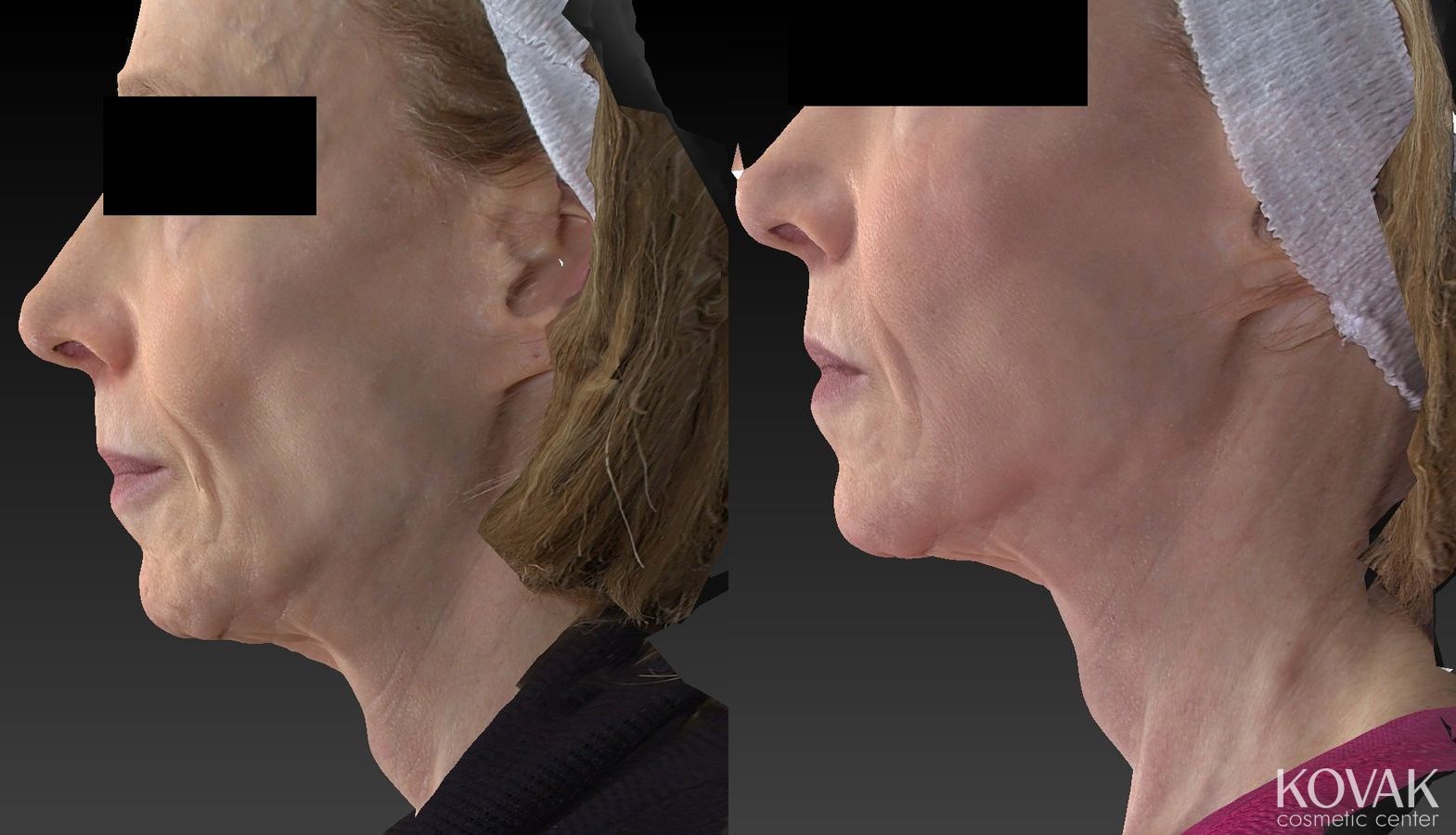 Before and after Sculptra® case 36464 - Angle 5