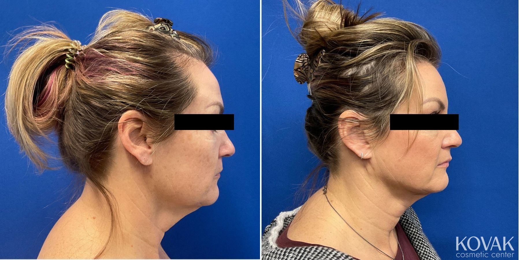 Before and after VLR - Vaser Laser - Jawline Sculpting case 36773