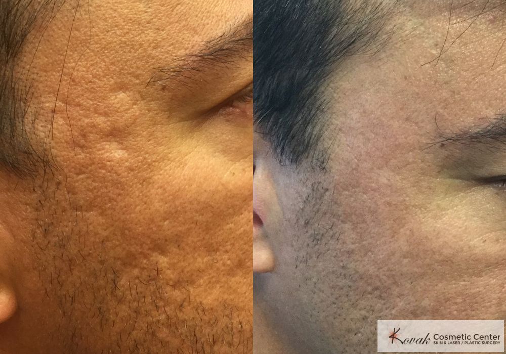 Acne Scars - Thumbnail 2