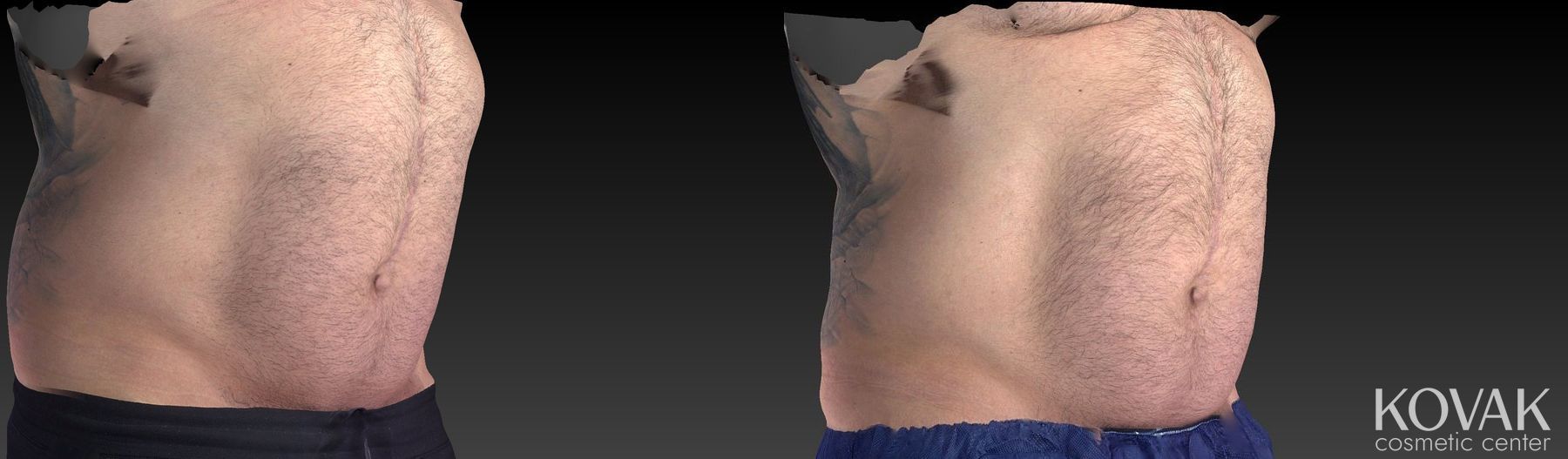 Before and after CoolSculpting® case 36562 - Angle 2