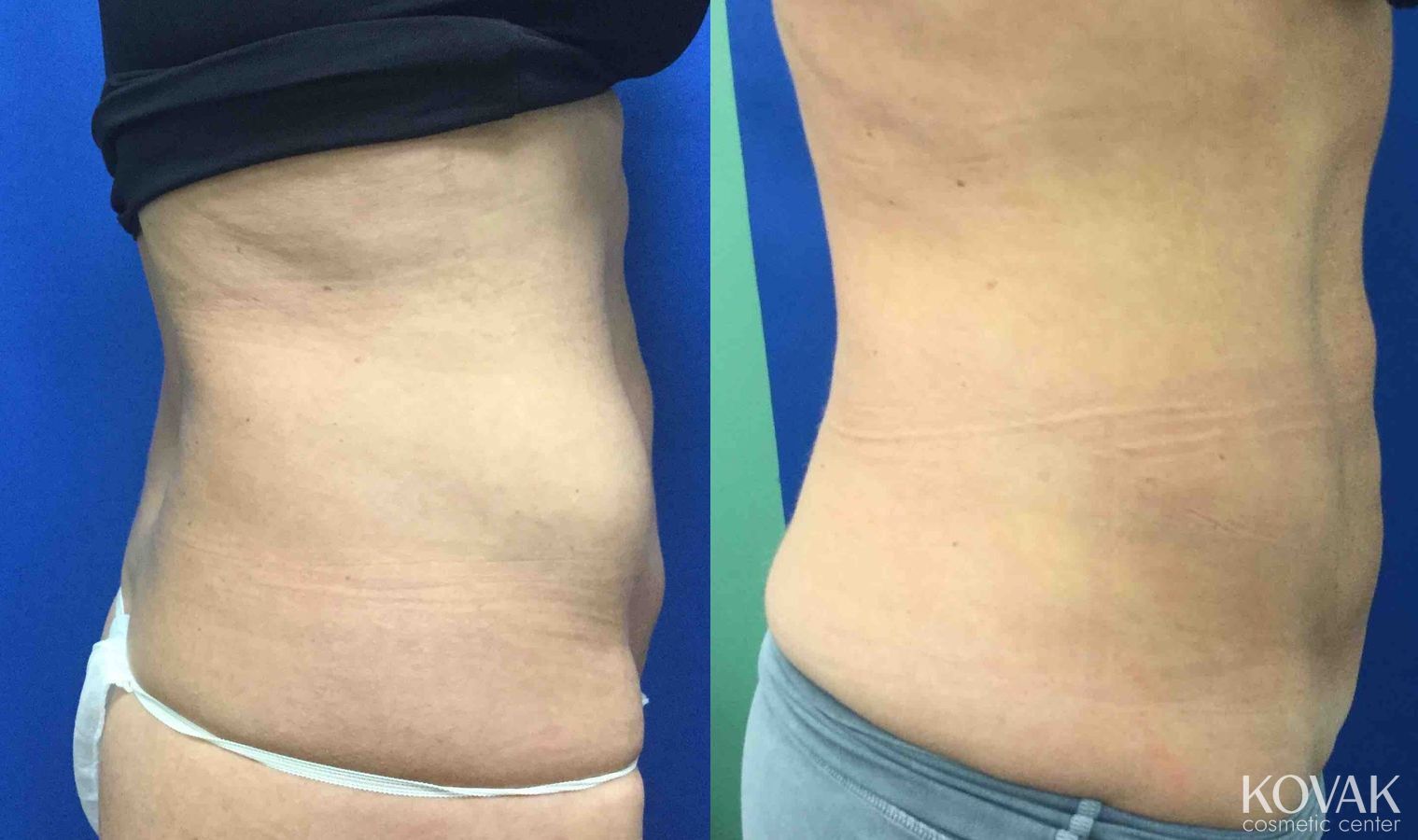 Before and after EMSCULPTĀ® case 36684 - Angle 3