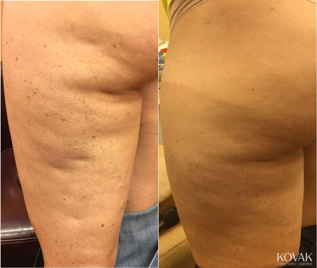 Before and after Cellulite Reduction case 36520 - Angle 2