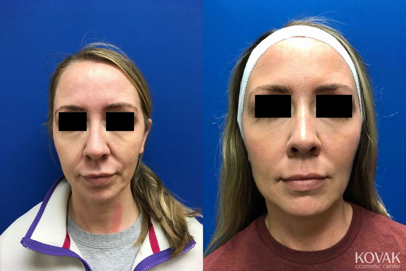 Before and after Injectables - Face case 36656