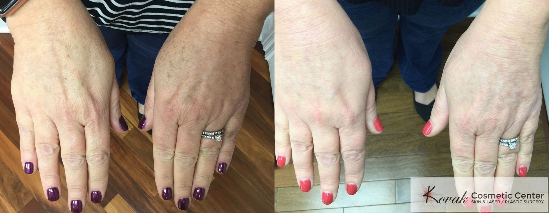 Tyte and Bryte Photorejuvenation - Case 1705