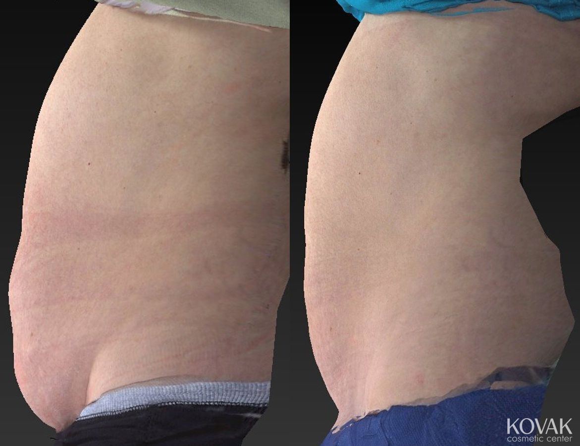 Before and after CoolSculpting® case 36459 - Angle 5