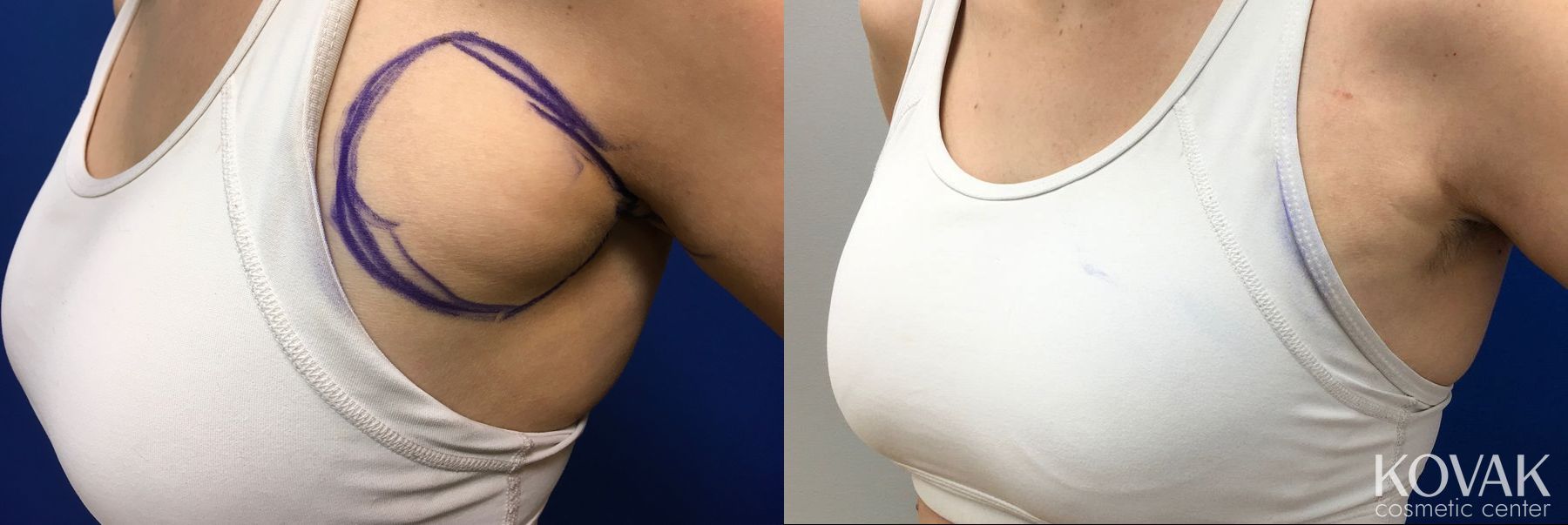 Before and after Liposuction case 36652