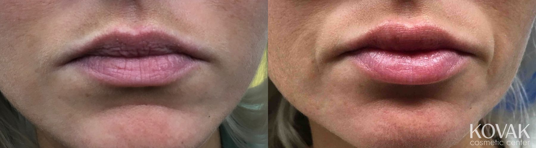 Before and after Injectables case 36650