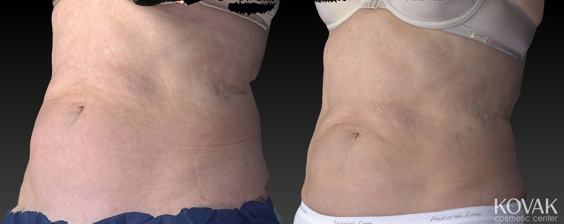 Before and after CoolSculpting® case 36484