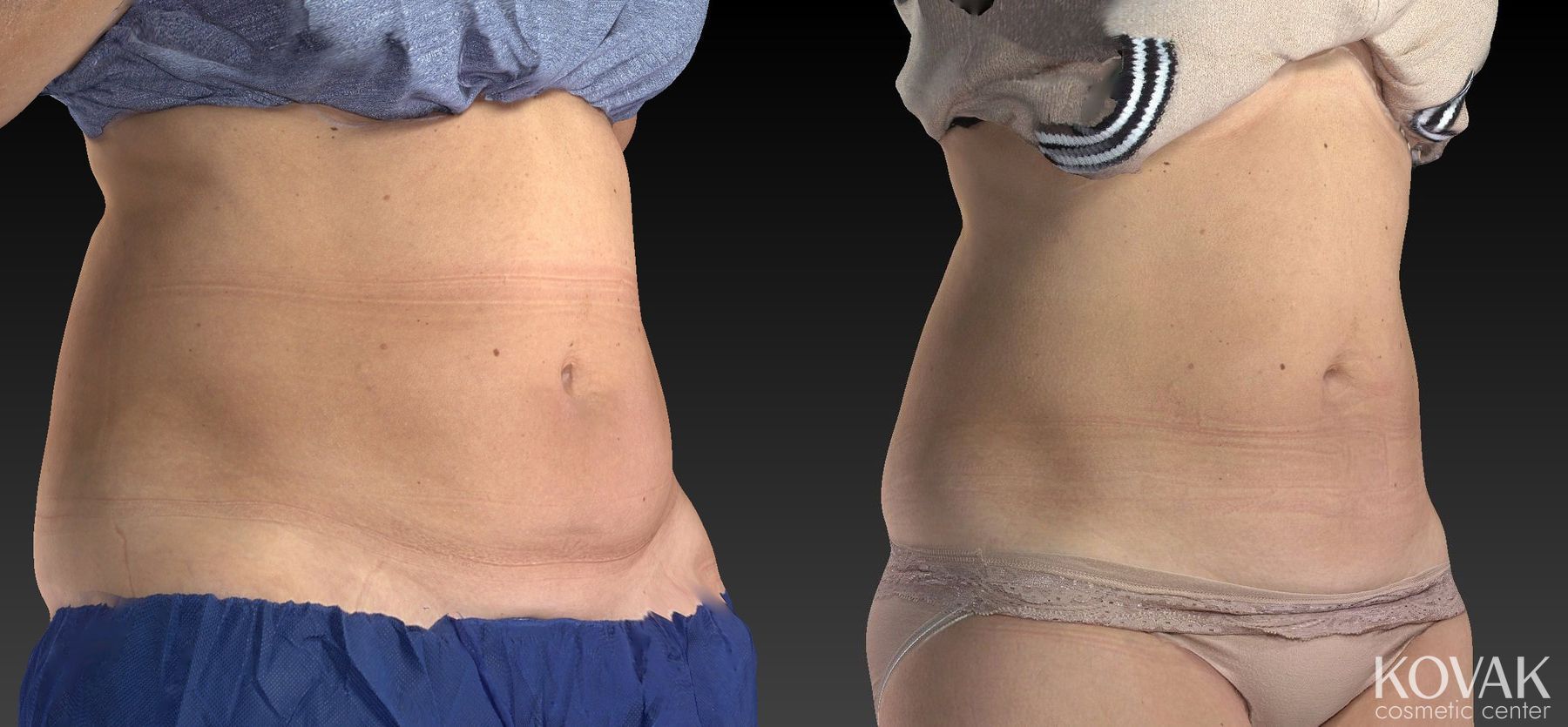 Before and after CoolSculpting® case 36486 - Angle 2