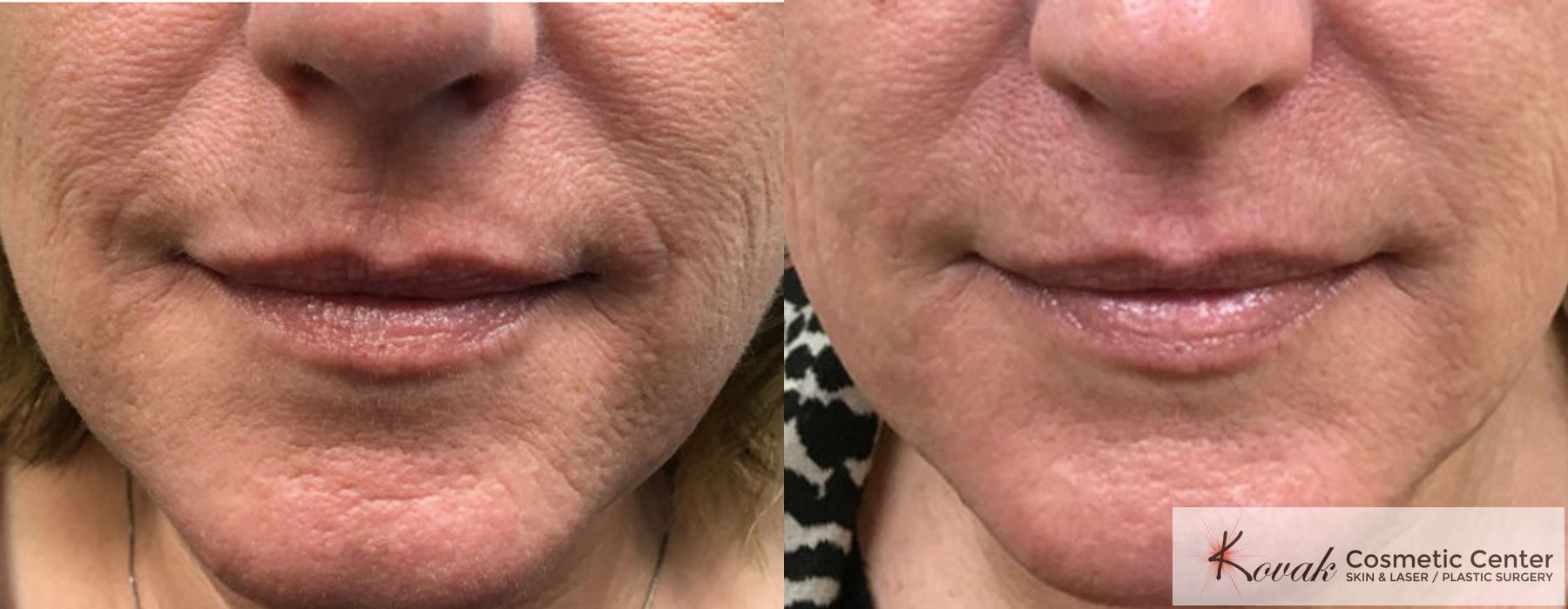 Restylane® Silk - Case 1688