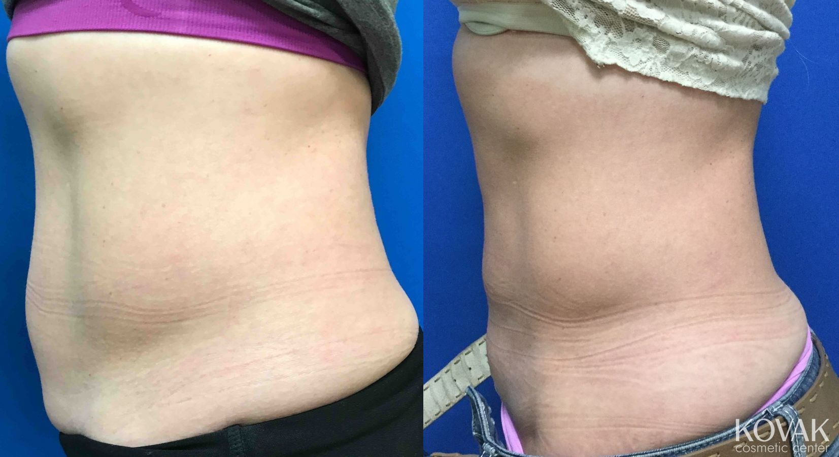 Before and after CoolSculpting® case 36461 - Angle 2