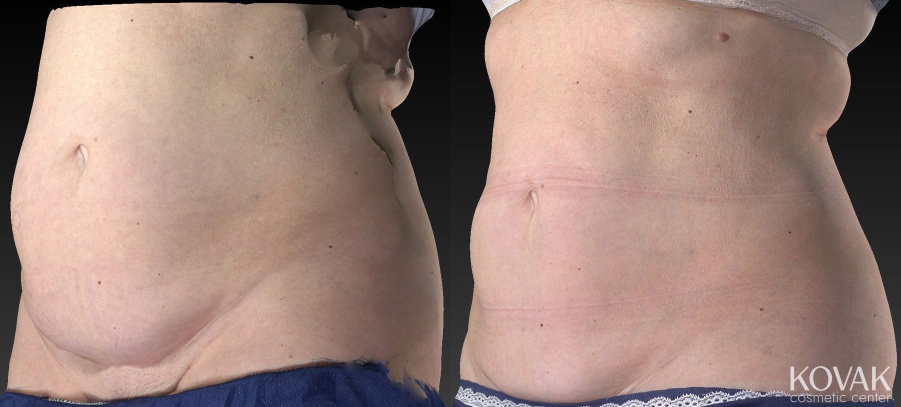 Before and after CoolSculpting® case 36485 - Angle 3