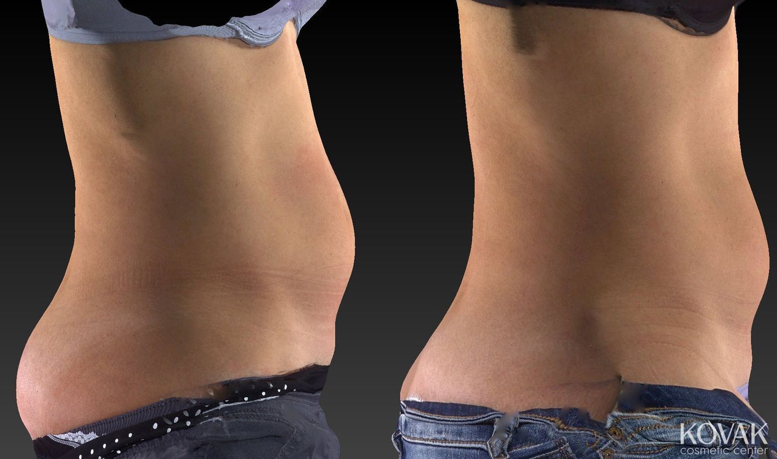 Before and after CoolSculpting® case 36479 - Angle 2