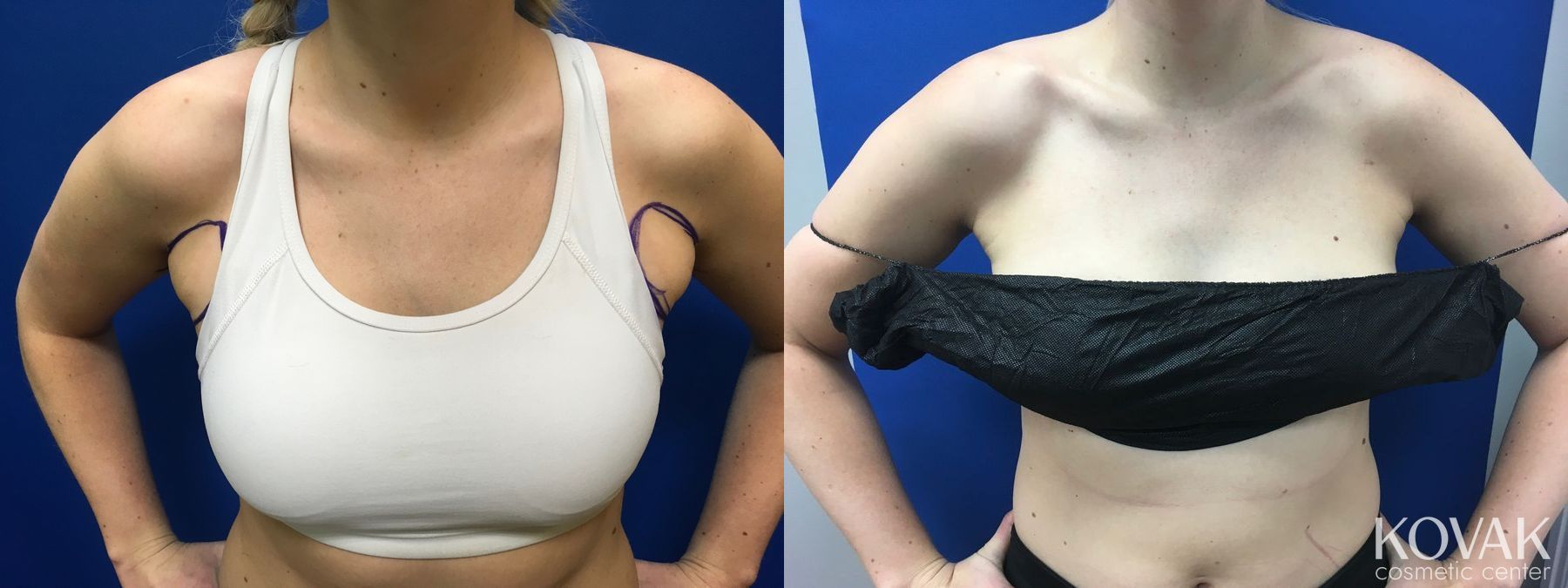 Before and after Laser Liposuction case 36663 - Angle 2