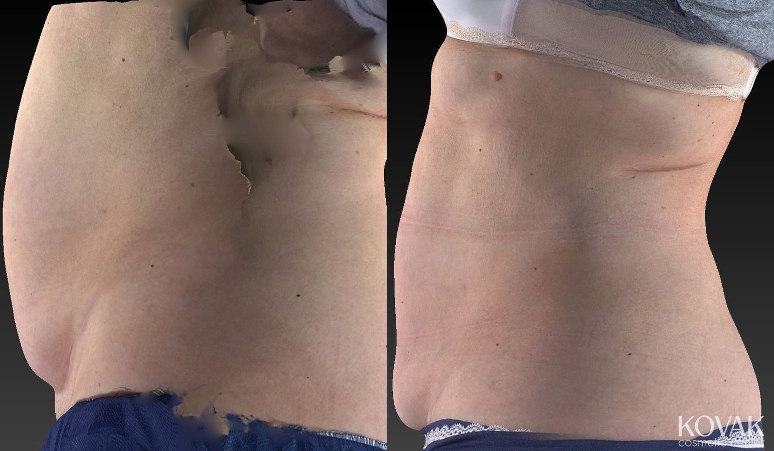Before and after CoolSculpting® case 36485 - Angle 4