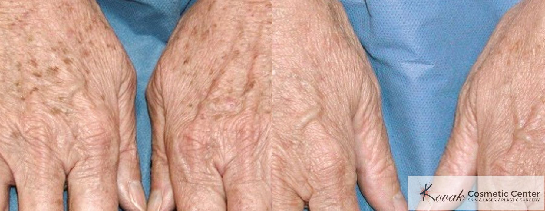 Tyte and Bryte Photorejuvenation - Case 1710