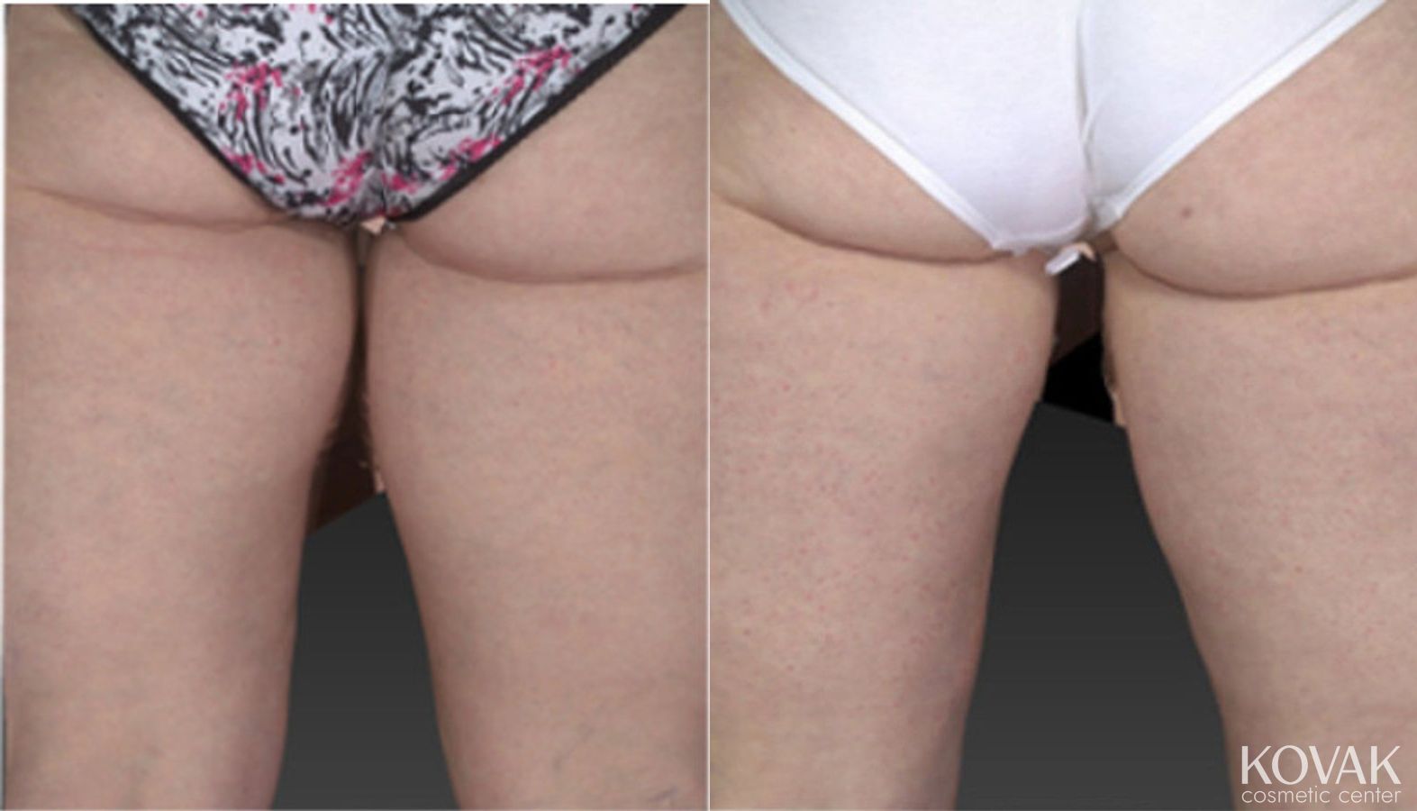 Before and after CoolSculpting® case 36514