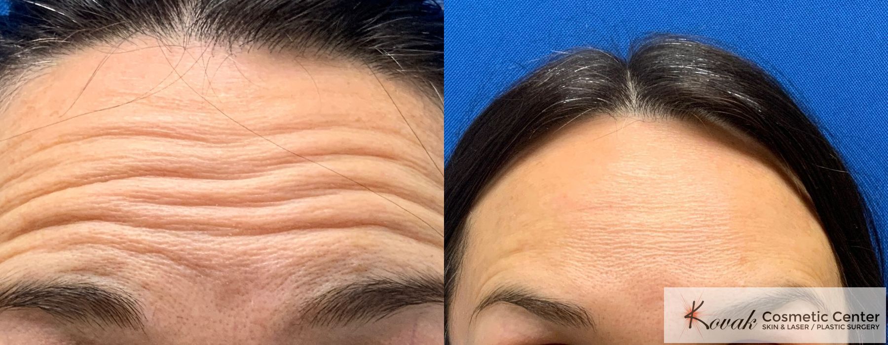 Neurotoxin (Botox, Jeuveau, Dysport & Xeomin) - Case 1539