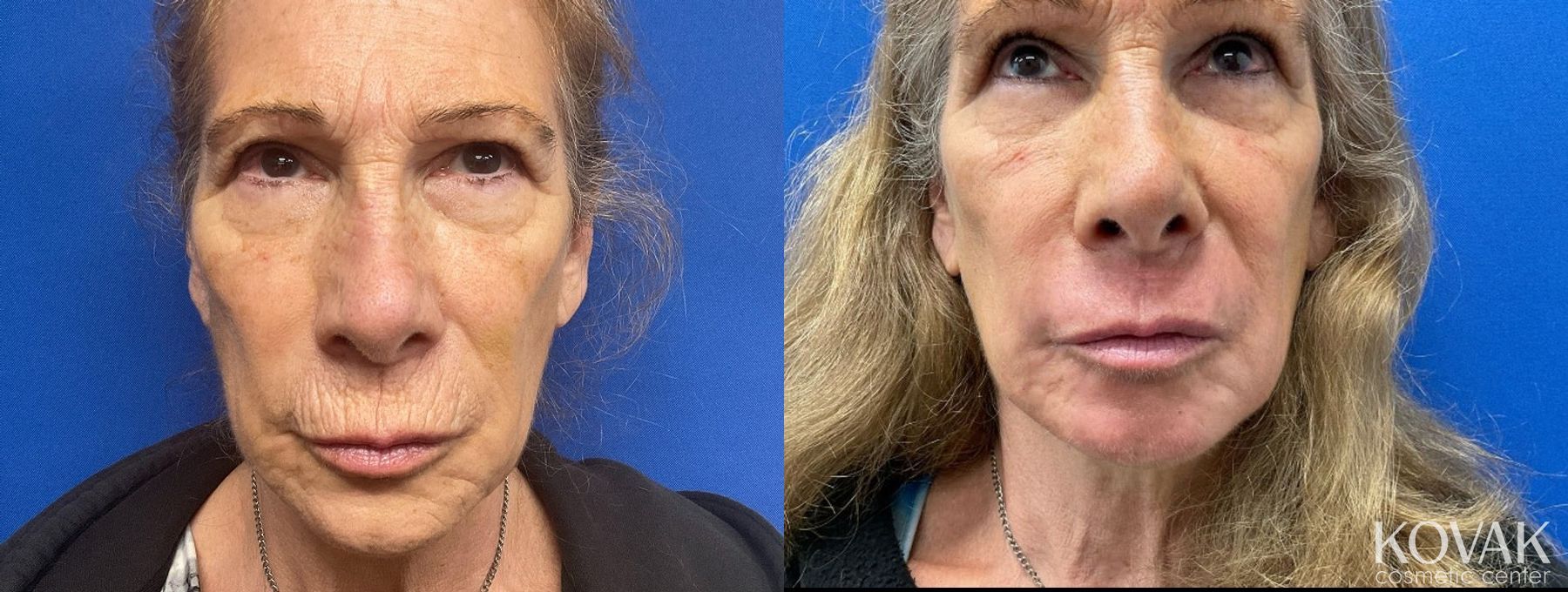 Before and after Resurfacing case 36771