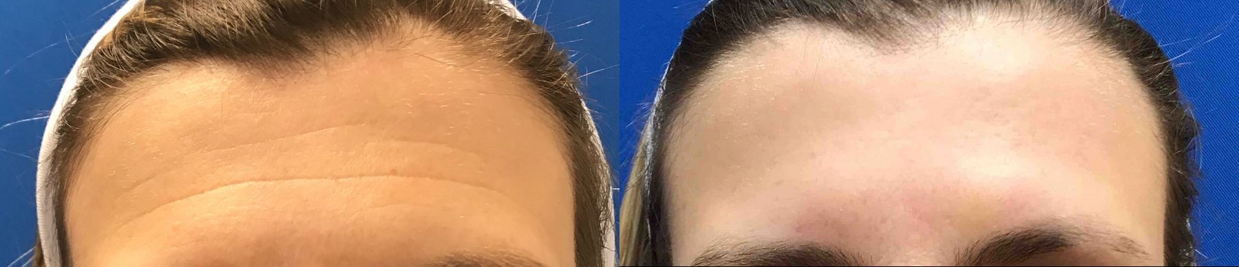 Before and after Forehead Lines case 36627