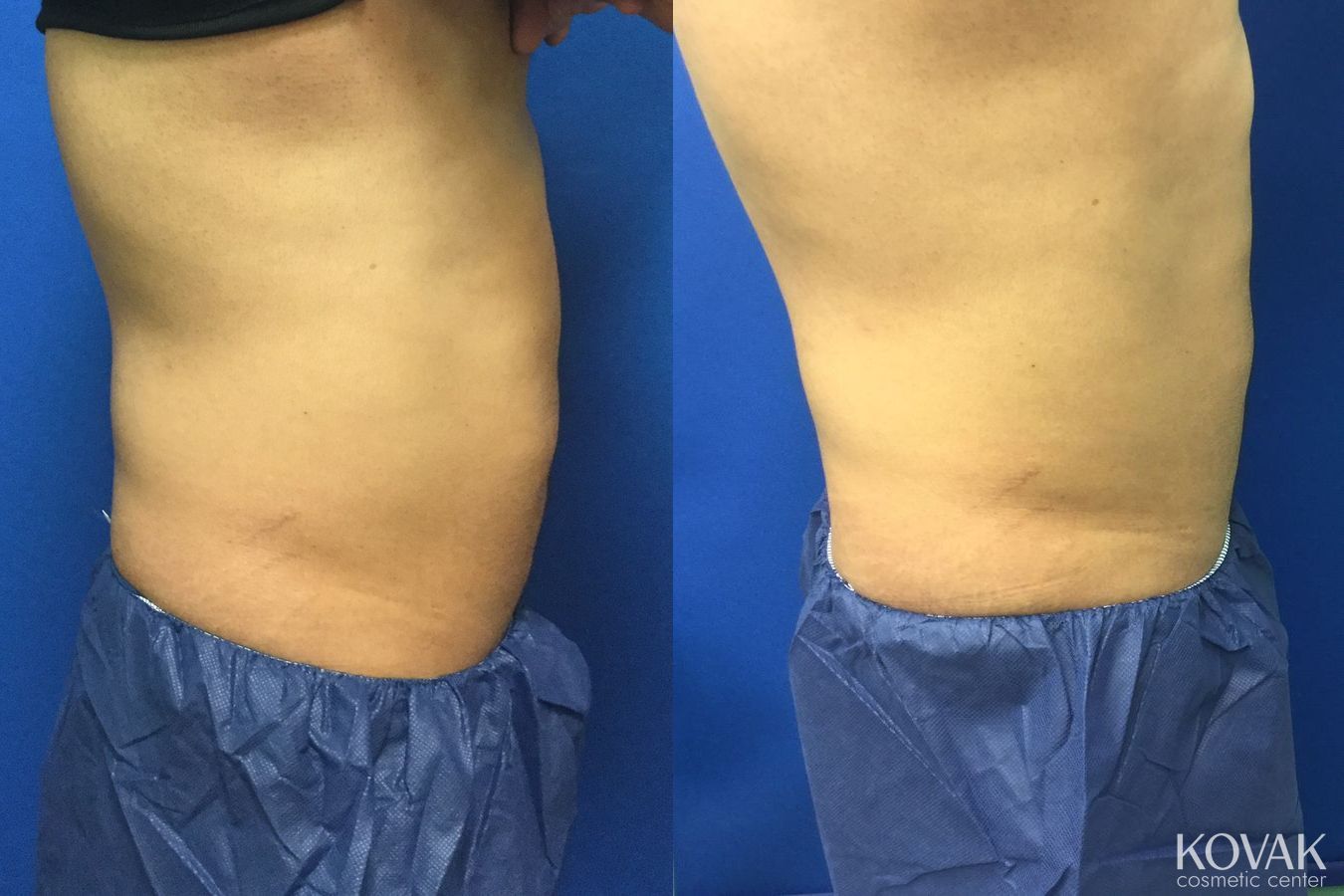 Before and after EMSCULPTĀ® case 36600 - Angle 3
