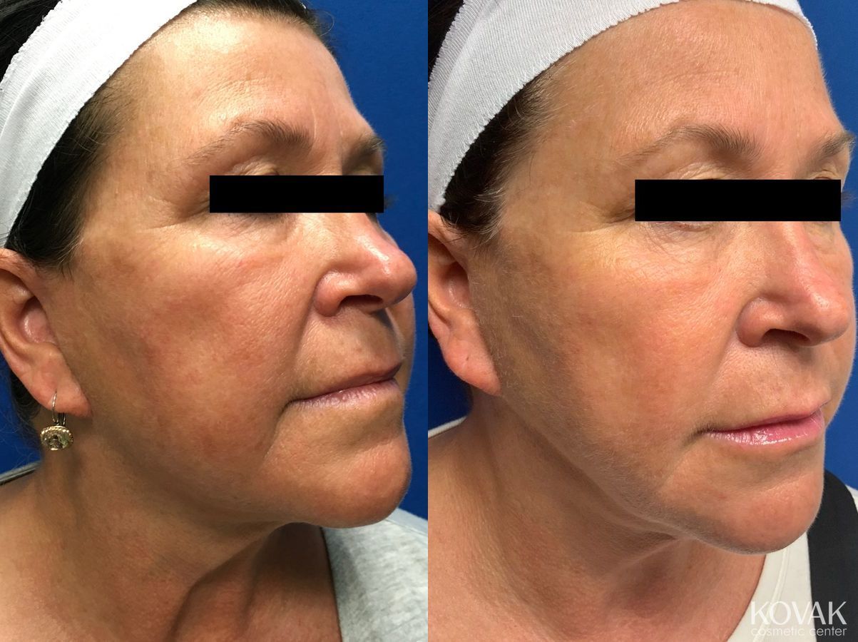 Before and after Laser Liposuction case 36743 - Angle 2