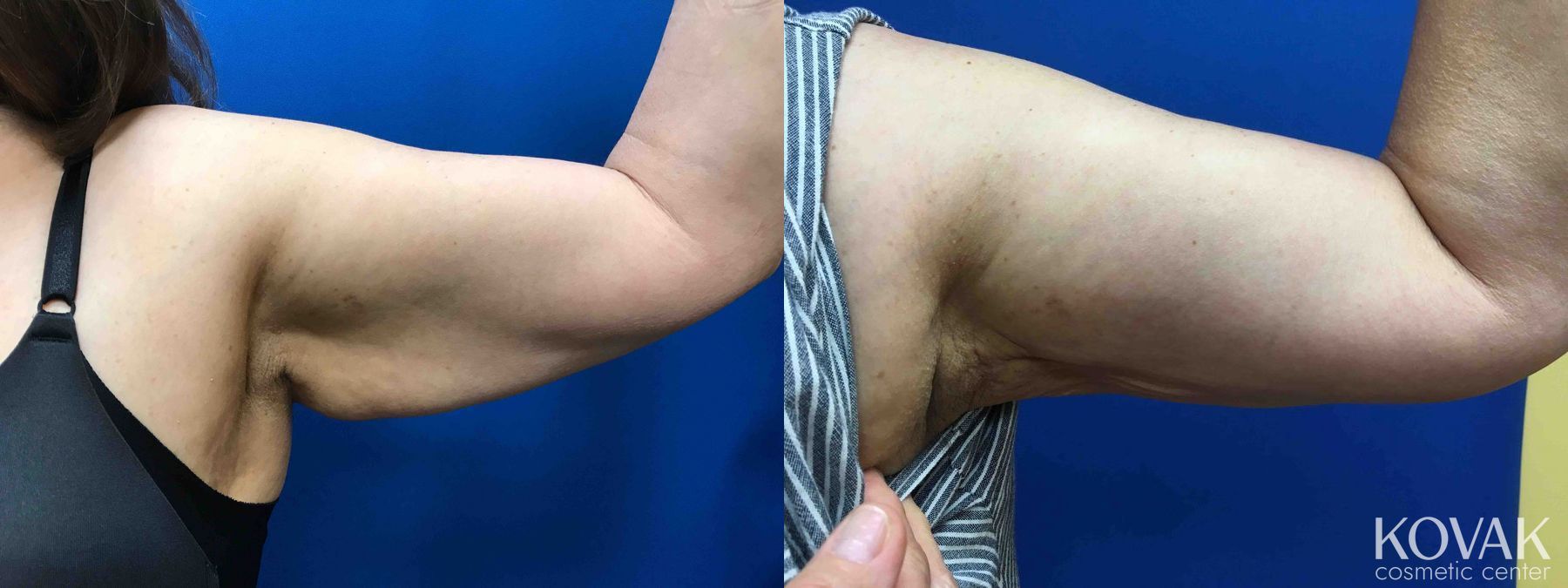 Before and after Laser Liposuction case 36662 - Angle 2
