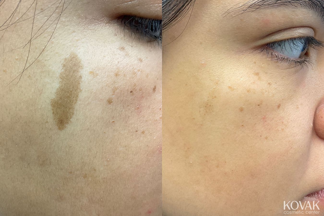 Before and after Birthmarks case 36735