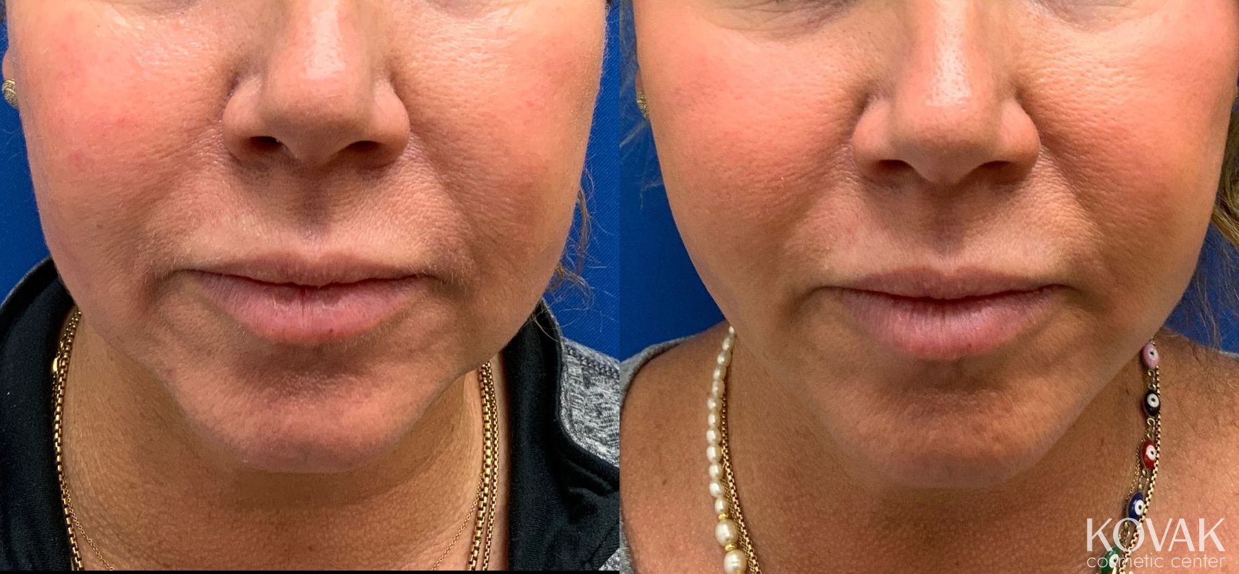 Before and after Laser Liposuction case 36746