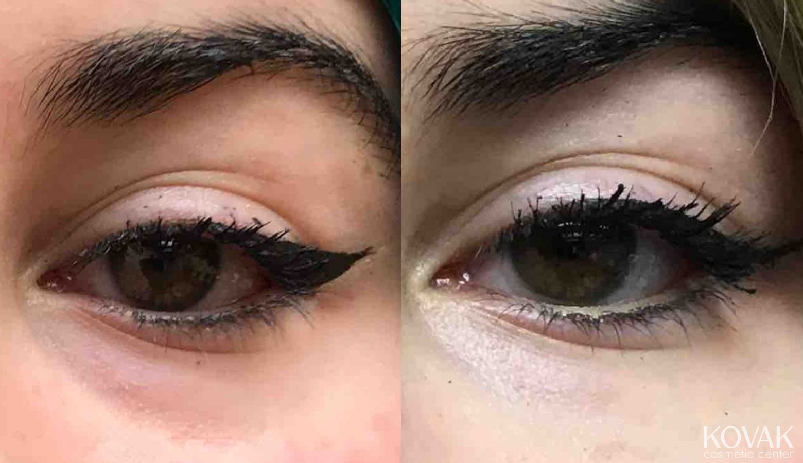 Before and after Eye Treatments case 36457 - Angle 2