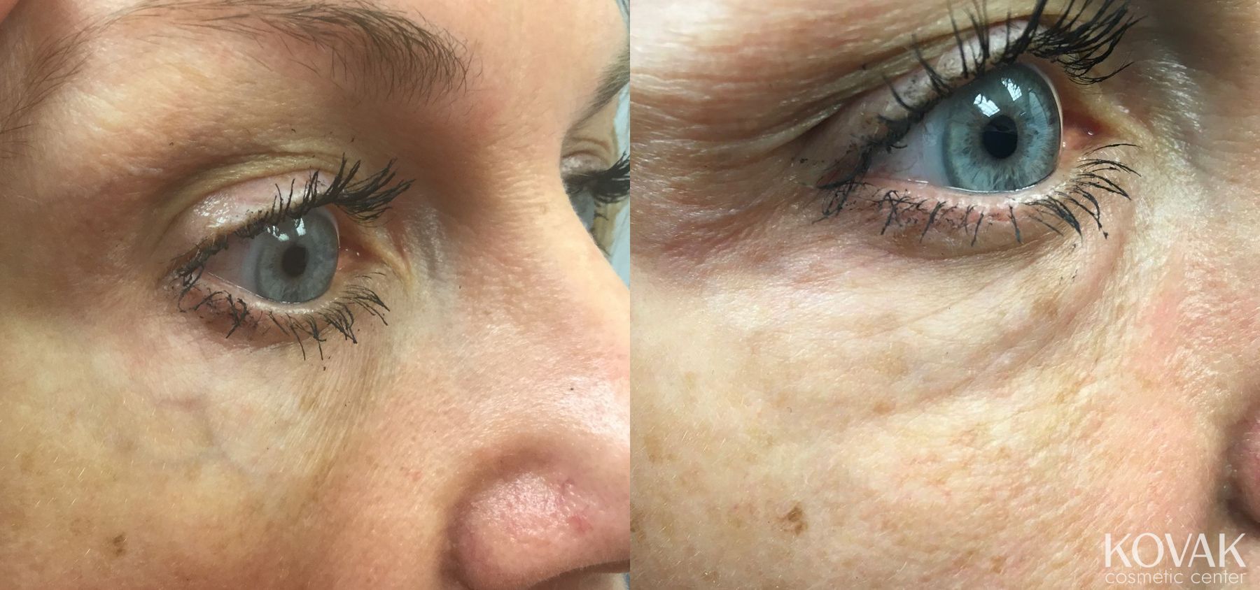 Before and after Eye Vein Treatment case 36476