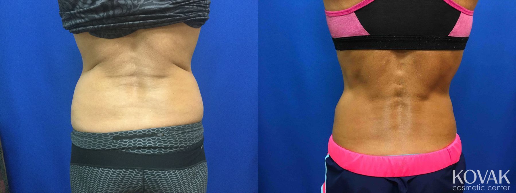 Before and after CoolSculpting® case 36666 - Angle 2