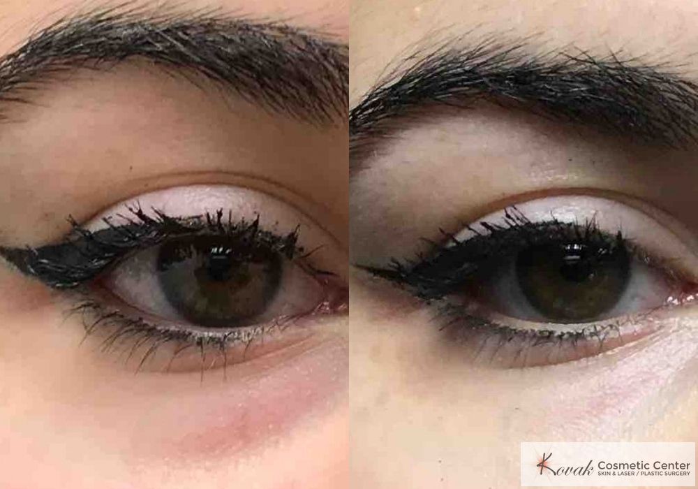 Eye Treatments - Case 1486