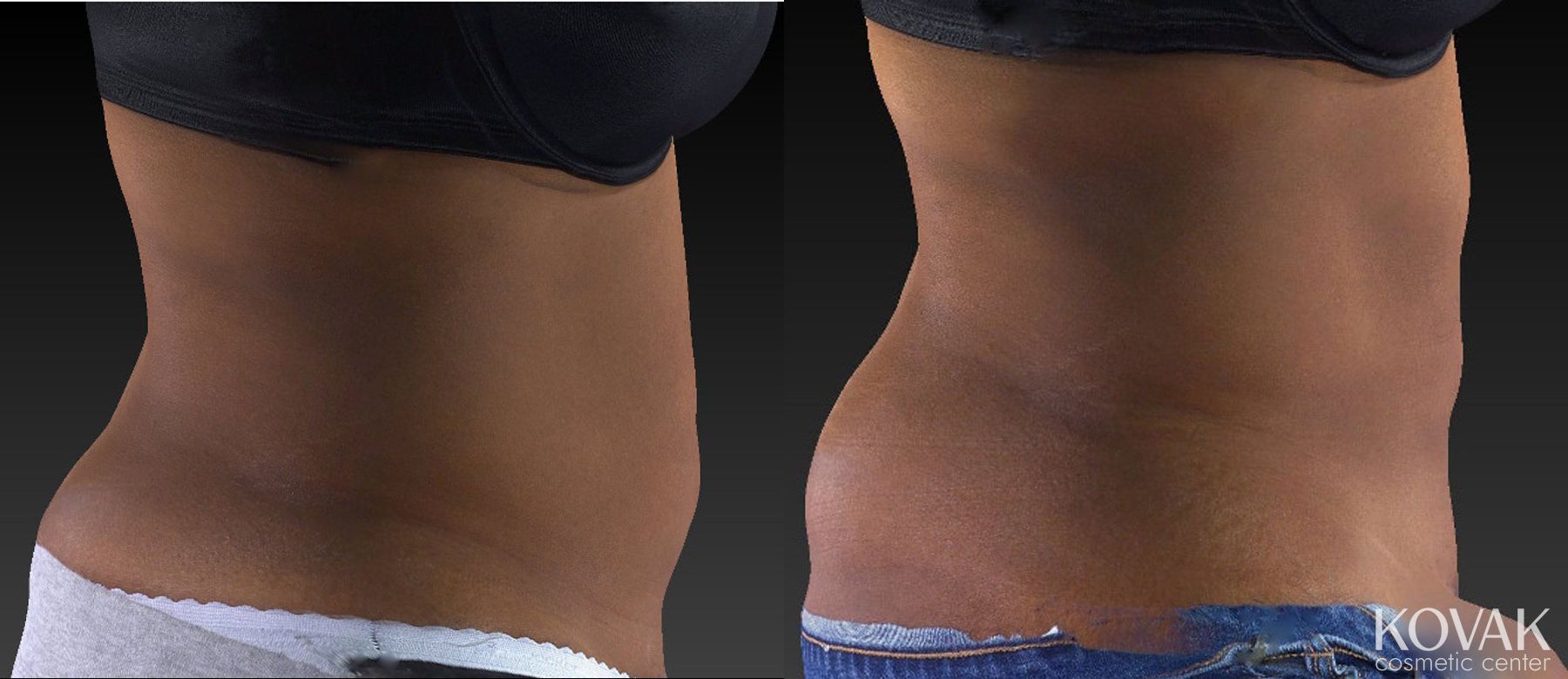 Before and after CoolSculpting® case 36505 - Angle 3